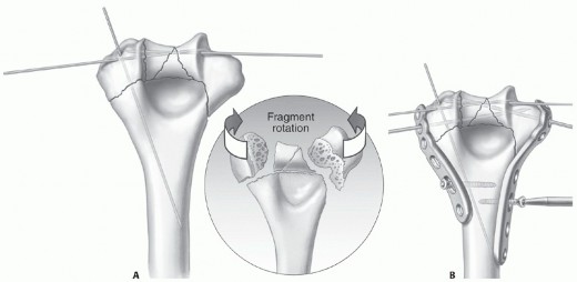 Mastering Supracondylar & Intercondylar Fracture Fixation