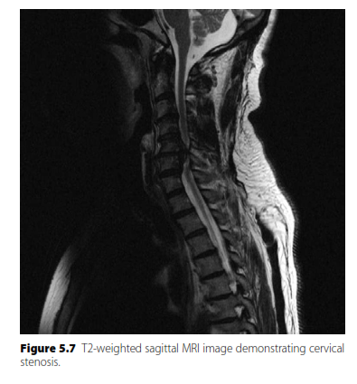 Illustration 4 for Oral Questions Lumbar: Master Spinal Stenosis & Myelopathy
