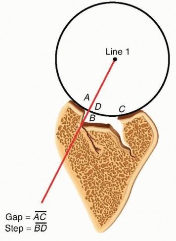 Precision Correction for Distal Radius Malunion