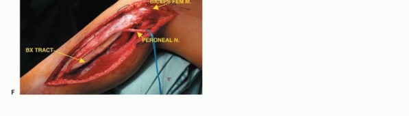 Illustration 33 for Beyond Amputation: The Type I Resection in Fibular Tumor Surgery