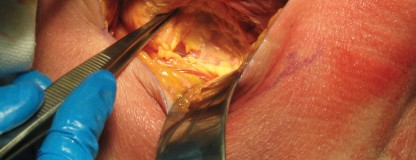 Illustration 3 for Minimally Invasive THA: Navigating Techniques, Benefits & Pitfalls