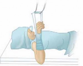 Illustration 10 for Precision Arthroscopy for Chondral Injuries & OCD: Direct Lateral Portal