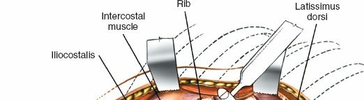 Illustration 403 for Approach to the Lumbar Spine: Mastering Techniques & Anatomy