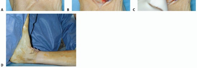 Illustration 27 for HINTEGRA Total Ankle: Unlocking Natural Ankle Movement