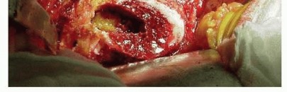 Illustration 14 for Cemented Total Hip: A Successful & Evidence-Based Solution