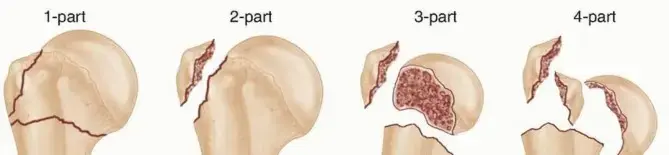 صورة توضيحية لـ كسور عظم العضد القريب: دليل شامل للمرضى في اليمن والخليج مع الأستاذ الدكتور محمد هطيف