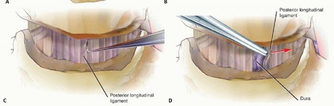 Illustration 17 for How ACDF Clears Your Posterior Disc Space for Lasting Relief