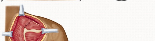 Illustration 18 for Snapping Scapula Syndrome: Why Your Shoulder Clicks & What to Do