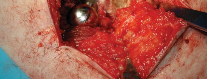Illustration 9 for Femoral Stem Revision: Posterior Approach for Better Outcomes