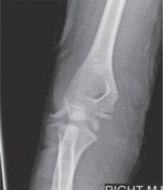Deciphering Flexor Carpi Radialis Injuries in Pediatric Cases