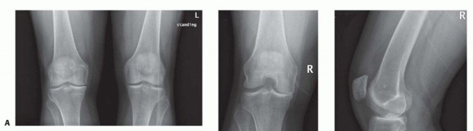 Unicondylar Knee Arthroplasty: Is This Your Solution to Knee Pain?