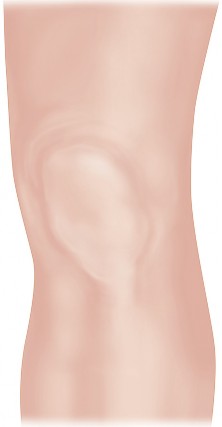 Illustration 5 for Minimal Incision Total Knee: Experience Faster Healing