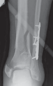 Illustration 27 for Optimizing ORIF for Tibial Plafond Fractures: A Modern Approach