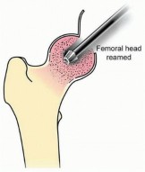 Illustration 9 for Head-Sparing for Osteonecrosis of the Femoral: Preserve Your Hip