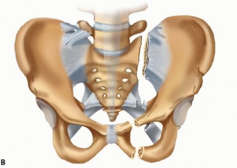 Illustration 2 for Emergency Fixation of the Pelvis: Control Bleeding & Restore Stability