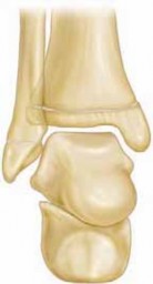 Hemi-Epiphysiodesis for Ankle Valgus: Effective Correction