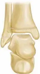 Hemi-Epiphysiodesis for Ankle Valgus: Effective Correction