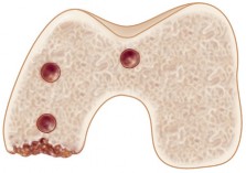 صورة طبية: مراجعة استبدال الركبة الجزئي الفاشل دليلك الشامل للعلاج الناجح في صنعاء