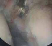 Illustration 23 for Resolving Femoral Head Neck Impingement: Arthroscopic FAI Solutions