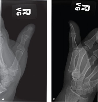 Diagnosing Basal Joint Arthritis: What Patients Who Present Need to Know