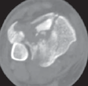 Illustration 37 for Optimizing ORIF for Tibial Plafond Fractures: A Modern Approach