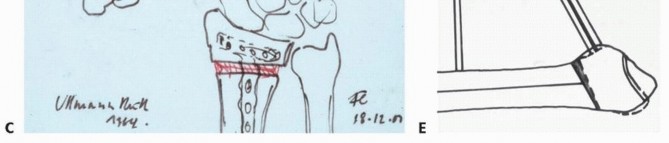Illustration 9 for Precision Correction for Distal Radius Malunion