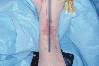 Illustration 32 for Mastering Valgus Total Knee Replacement: Techniques & Pitfalls