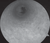 Illustration 14 for Successful Ligament Repair Revision: Fixing Failed ACLs