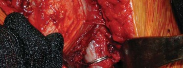 Illustration 59 for S-ROM: Inside the Technique of Modular Implant Design