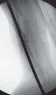 Illustration 20 for Solving Congenital Pseudarthrosis: Tibia with the Williams Rod