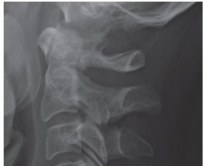 Illustration 28 for Stop Numbness & Instability: Corpectomy and Fusion Guide
