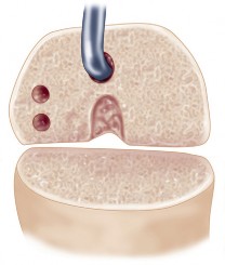 صورة طبية: مراجعة استبدال الركبة الجزئي الفاشل دليلك الشامل للعلاج الناجح في صنعاء