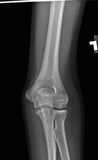 Illustration 93 for Right Shoulder Pain? Avoid This Common X-ray Mistake.