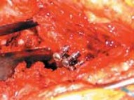 Illustration 27 for Advanced Arthroplasty for Malignant Lesions: Reclaim Your Mobility