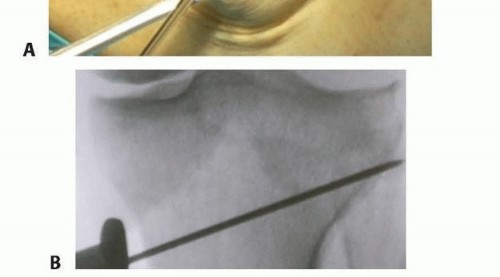 Illustration 12 for High Tibial Osteotomy: Realignment for Lasting Knee Pain Relief