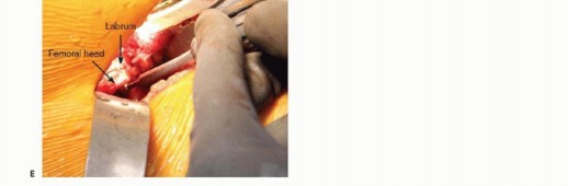 Illustration 22 for Anterior FAI Relief: Mini-Open Anterior Approach Explained