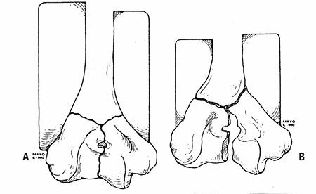 Distal Humerus Fractures: Understanding Causes, Anatomy & Epidemiology