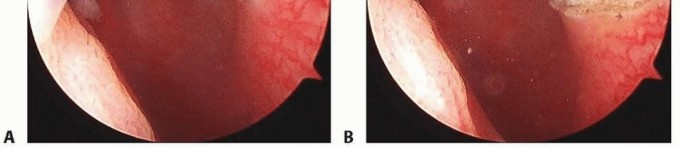 Is Lateral Release Knee Right for Your Patellofemoral Pain?
