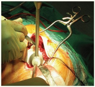 Illustration 24 for Cemented Acetabular Component: Achieving Optimal THA Stability