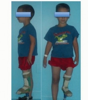 Illustration 10 for Treatment for Congenital Femoral Deficiency: What You Need to Know