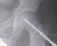 Treat SCFE with Percutaneous Screws: Richard S. Davidson's Guide
