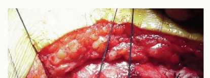 Illustration 18 for Cemented Total Hip: A Successful & Evidence-Based Solution