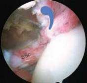 Illustration 21 for Arthroscopic Subscapularis Repair: The lo iky brady Method for Stability