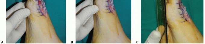 Illustration 22 for MTP Joint Arthrodesis: The Key to Optimal Toe Positioning