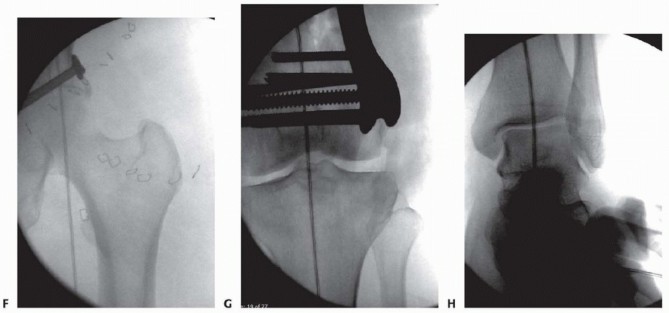 Illustration 58 for Repairing Distal Femur Fractures: Open Reduction & Internal Fixation