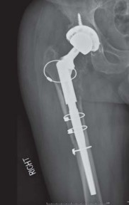 Illustration 24 for THA for patients with proximal femoral deformity: Practical solutions