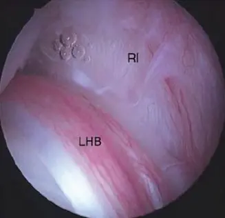 صورة توضيحية لـ التهاب وتر العضلة ذات الرأسين: دليلك الشامل للتشخيص والعلاج والتعافي على يد أفضل الخبراء في صنعاء