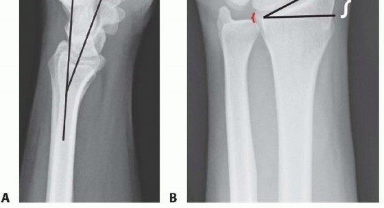 Illustration 4 for Effective K-Wire Fixation: Distal Radius Fractures Without External Fixation