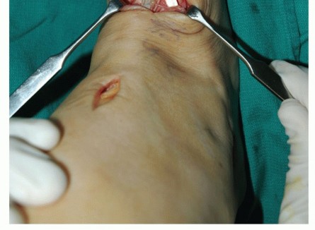 Illustration 62 for Restore Movement: Tendon Transfer for Common Peroneal Nerve Foot Drop