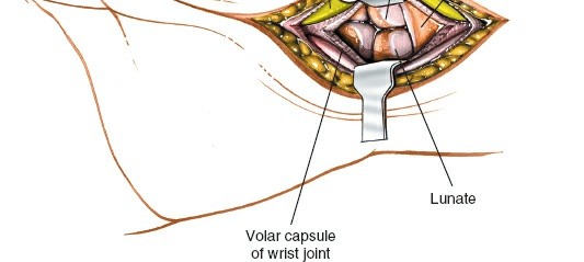 Illustration 75 for Essential Surgical Approaches: Uncover Every Aspect of the Wrist